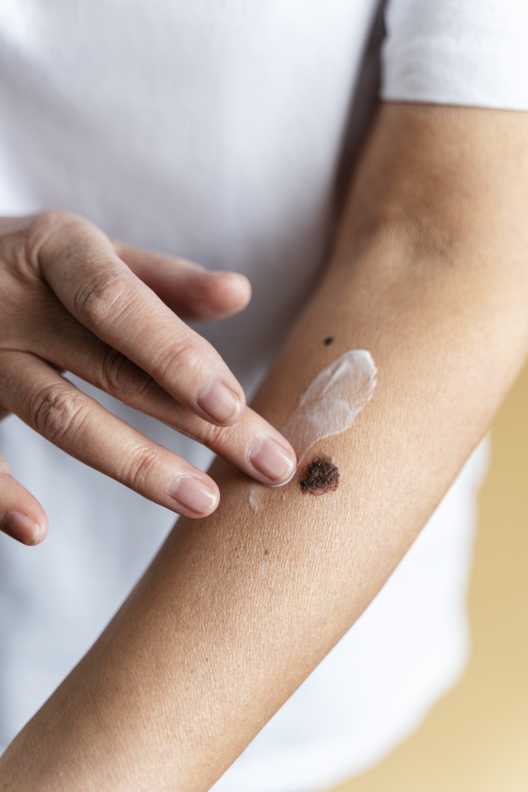 Lésion dermatologie téléconsultation